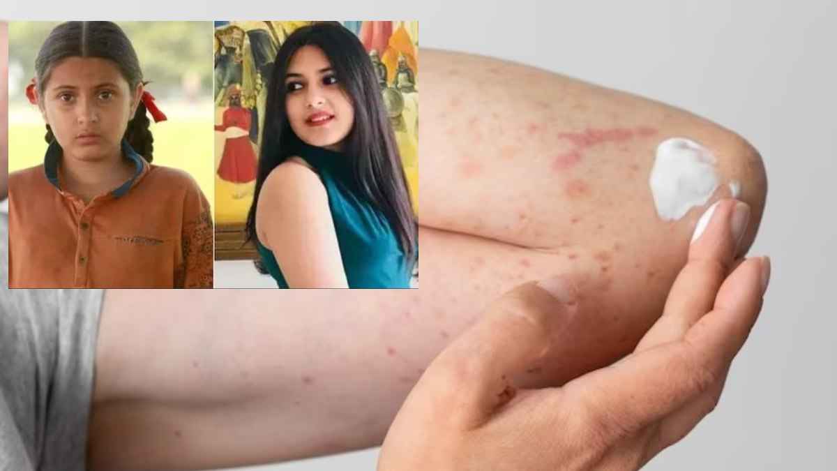 कौन सी दुर्लभ बीमारी से जूझ रही थी 'दंगल गर्ल'! आखिर क्या है Dermatomyositis और इसके लक्षण