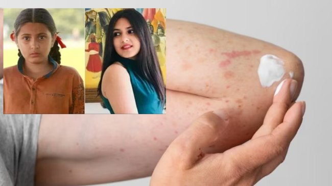 Dermatomyositis Disease Dermatomyositis Disease