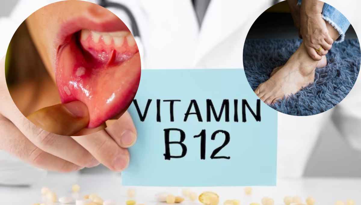 Vitamin B12 deficiency