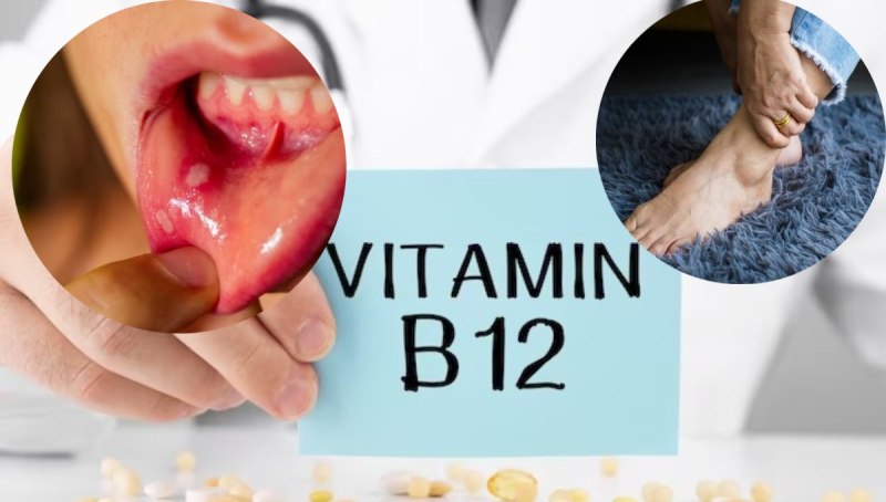 Vitamin B12 deficiency