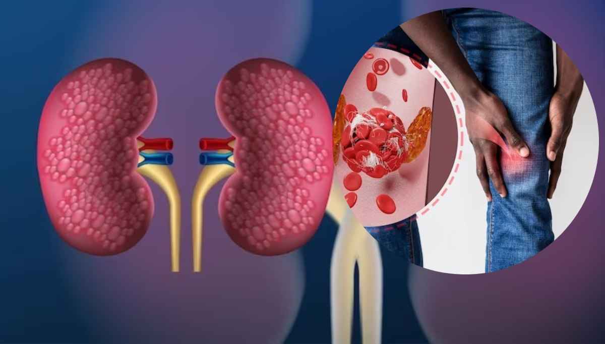kidney disease
