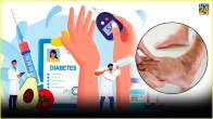 Diabetes Symptoms Causes and Treatment