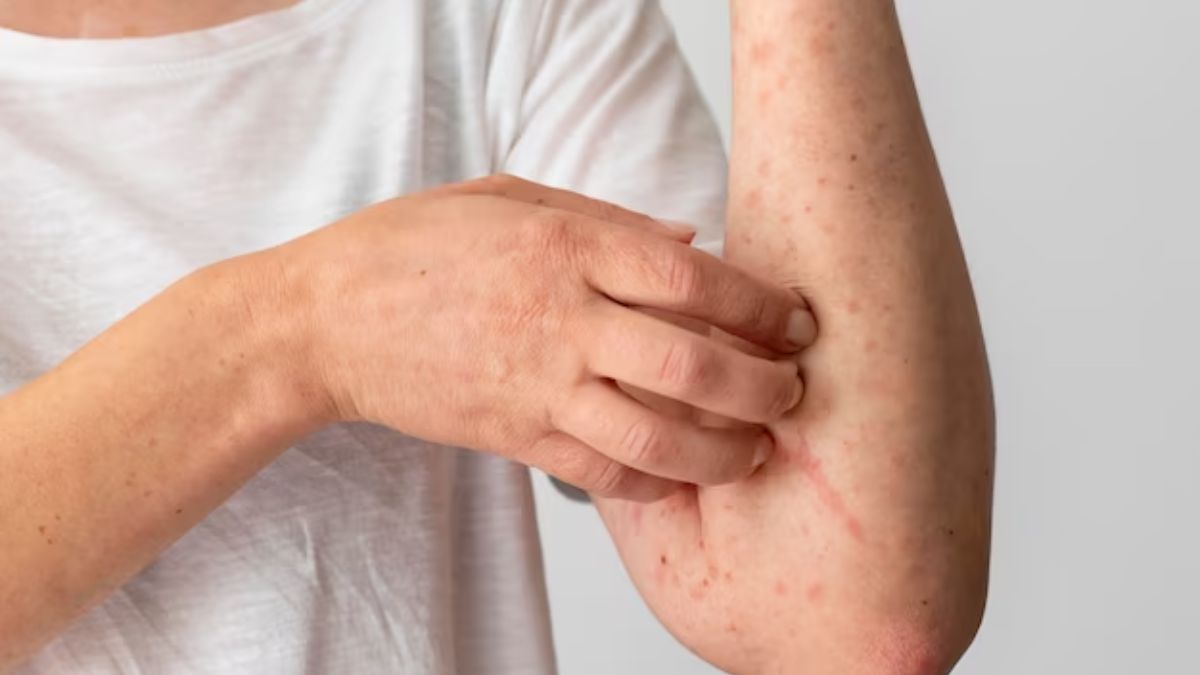 Natural Way to get rid of Skin Allergy