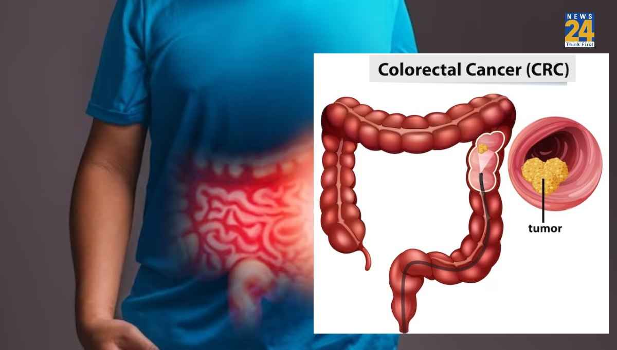 colon cancer