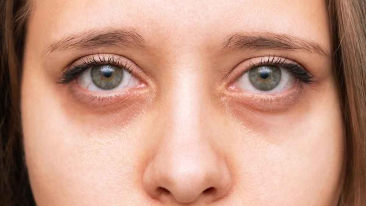 dark circles