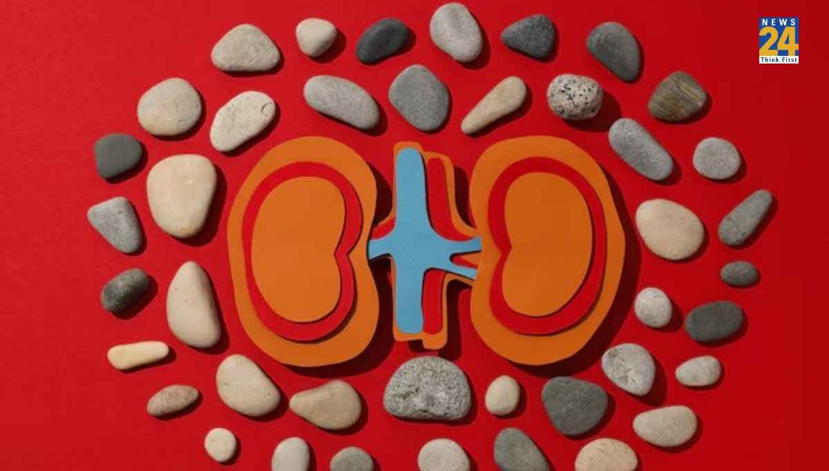 Kidney Stone: क्यों बनती है गुर्दे की पथरी? किन चीजों से करें परहेज ताकि बीमारी से रहें दूर