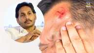 CM Jagan Mohan Reddy Injury