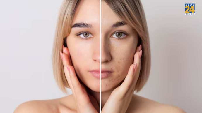 Home Remedies For Open Pores