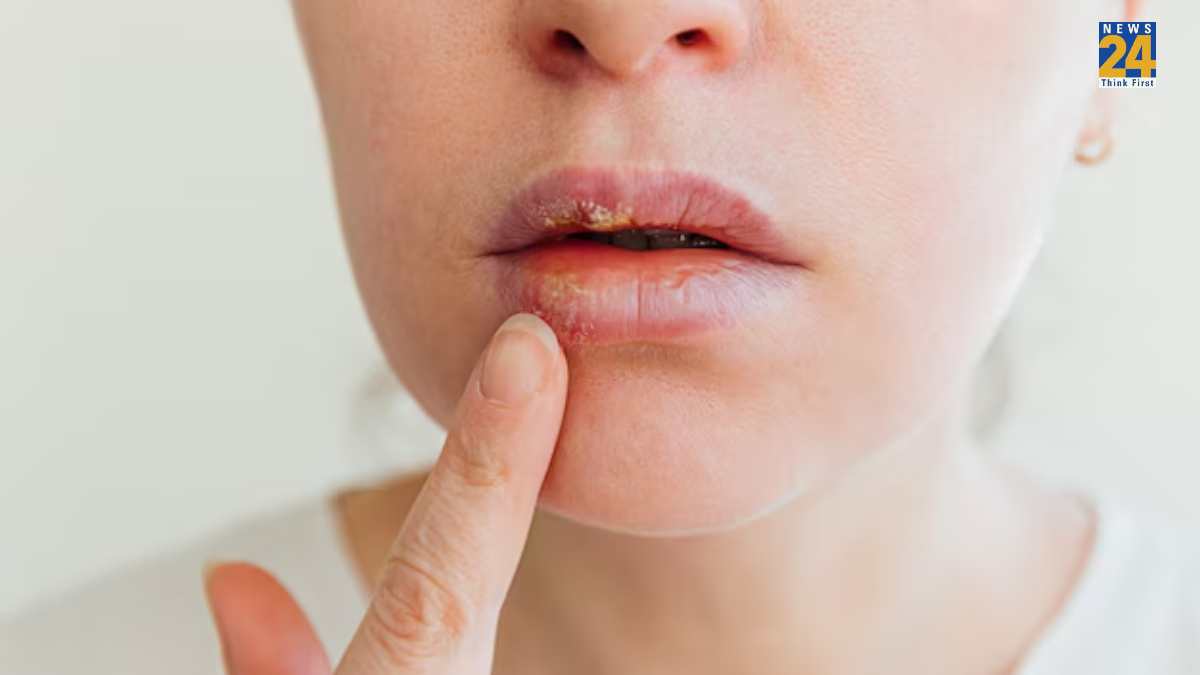 Home Remedies For dry lips