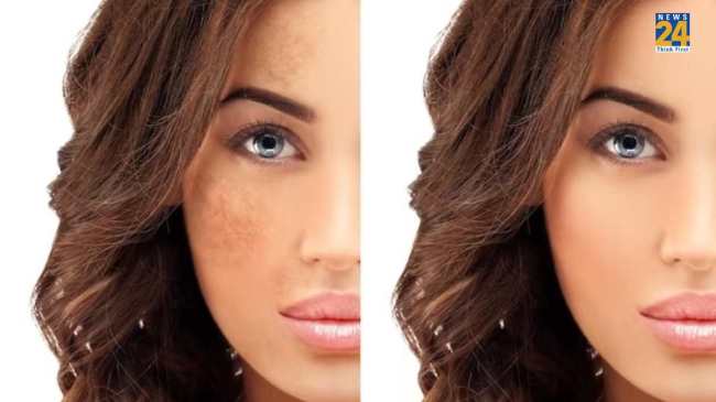 Home Remedies for Pigmentation