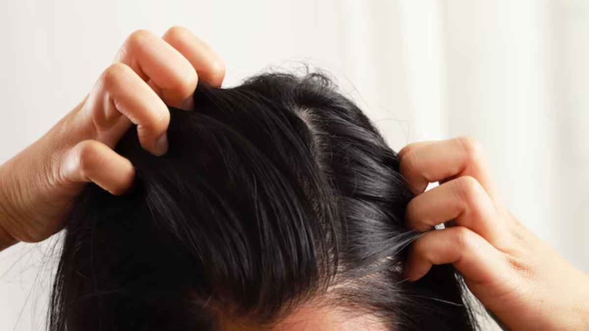 दिनभर सिर खुजलाने से मुक्ति दिलाएंगे 5 घरेलू नुस्खे, तुरंत दिखने लगेगा असर