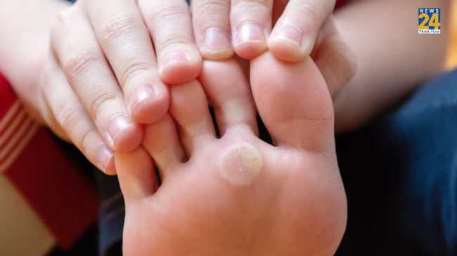 foot corn home remedies