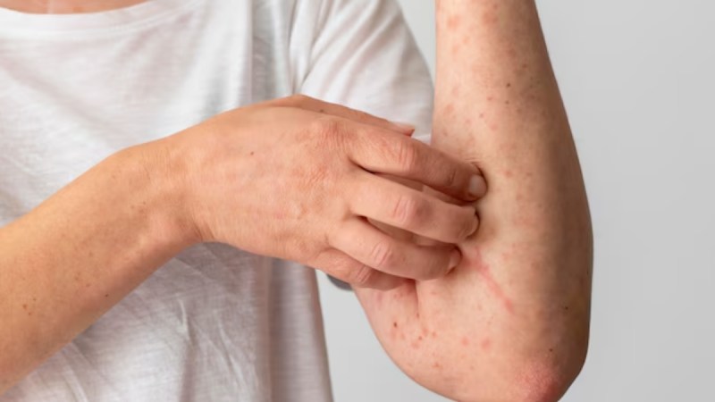how to get rid of heat rash
