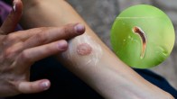 ringworm home remedies