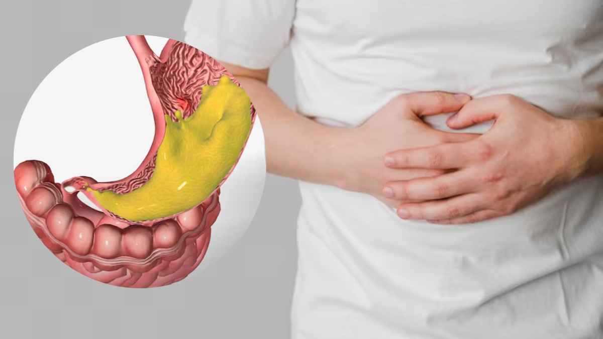 stress ulcer