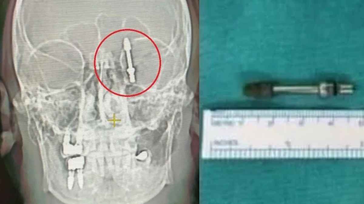 Mind Surgery