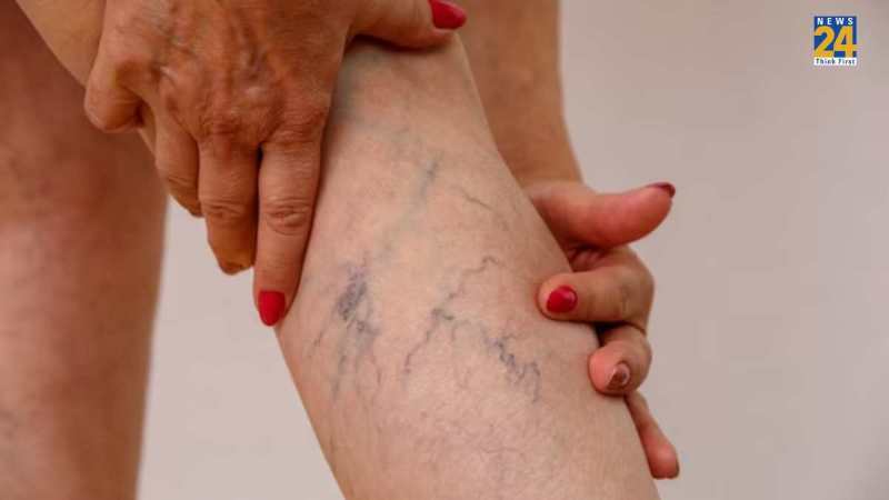 varicose veins home remedies