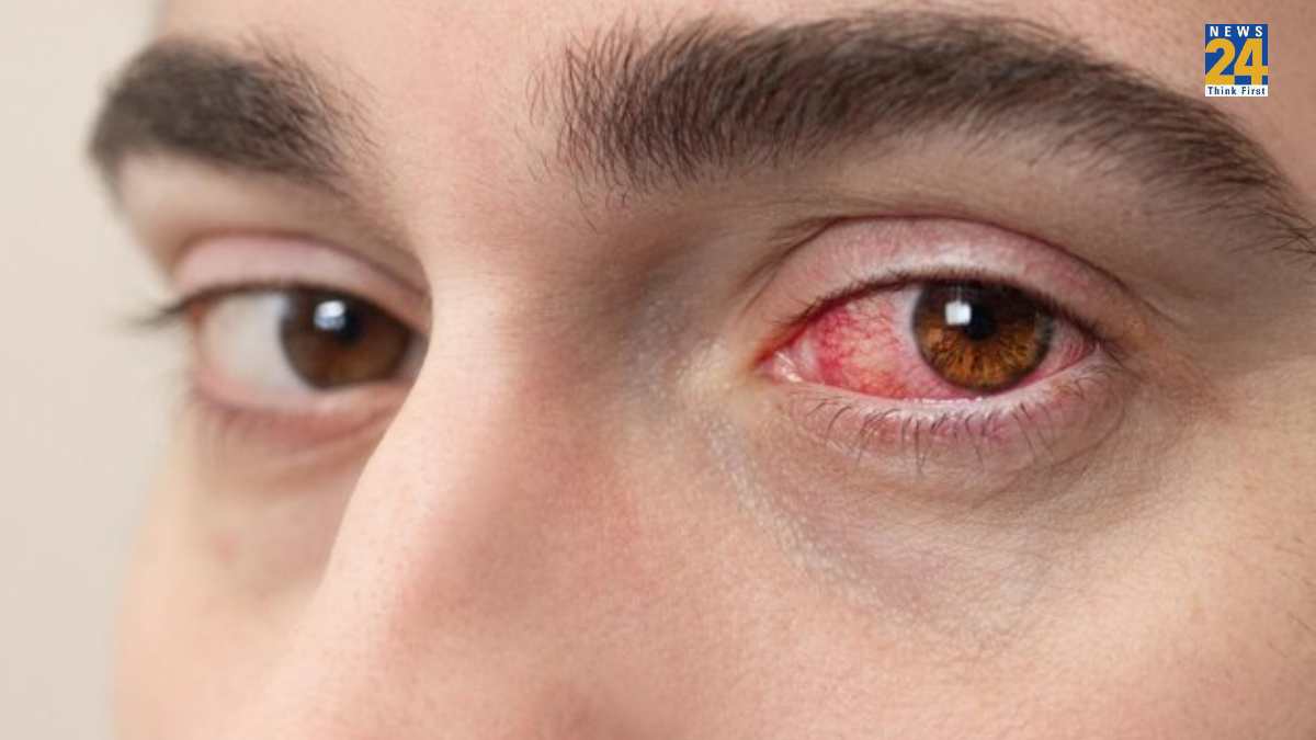 Avoiding Eye Infections