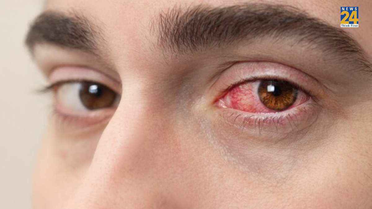 सावधान! गर्मियों में भी हो सकता है आई फ्लू; अभी जान लें बचाव के टिप्स