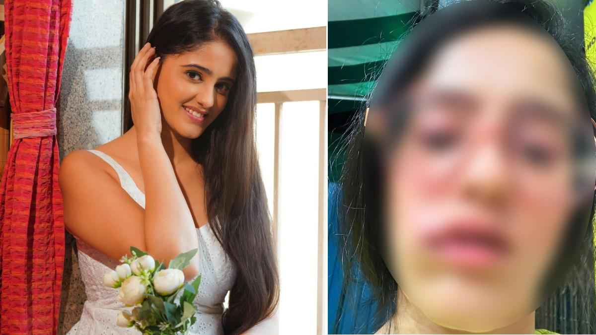 Actress Ayesha Singh Face Swollen