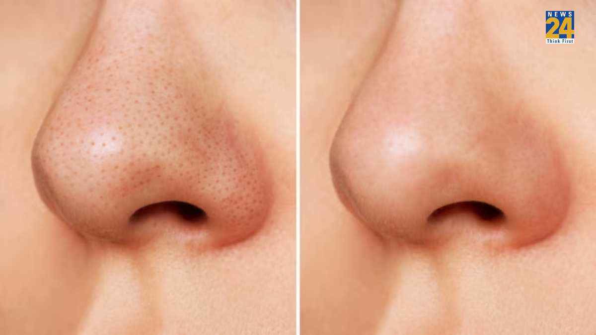 Blackheads से छुटकारा दिलाएंगे ये 5 नुस्खे