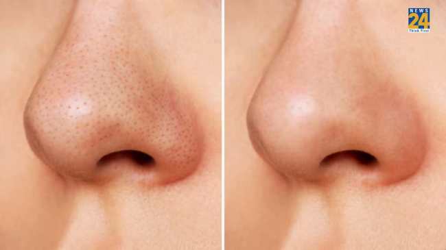 Blackheads Home Remedies