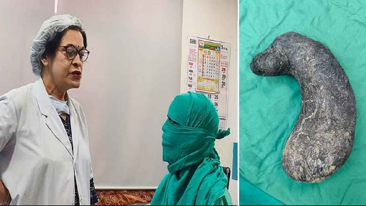 Bunch Of Hair Found in Woman Stomach