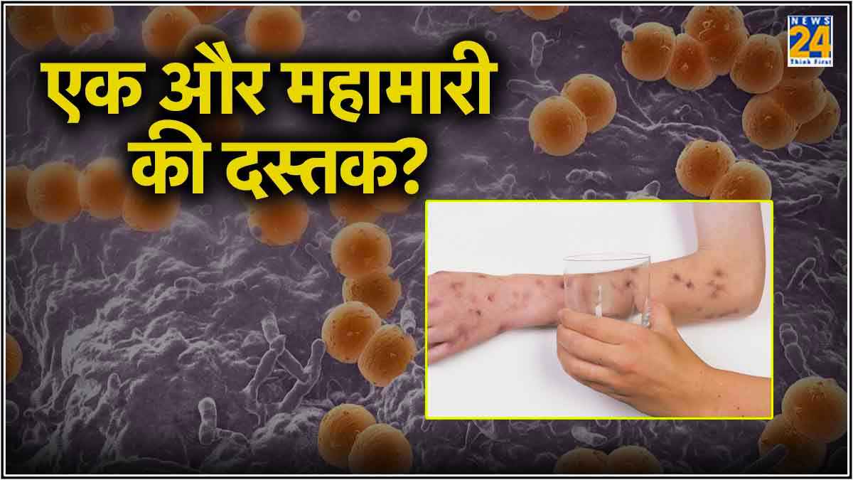 कोरोना से भी खतरनाक बीमारी की दस्‍तक, KISS करना भी जानलेवा! सऊदी से लौटे लोगों में द‍िख रहे लक्षण