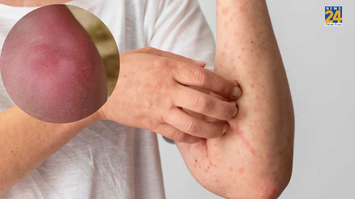 How To Get Rid Of Hives On Body