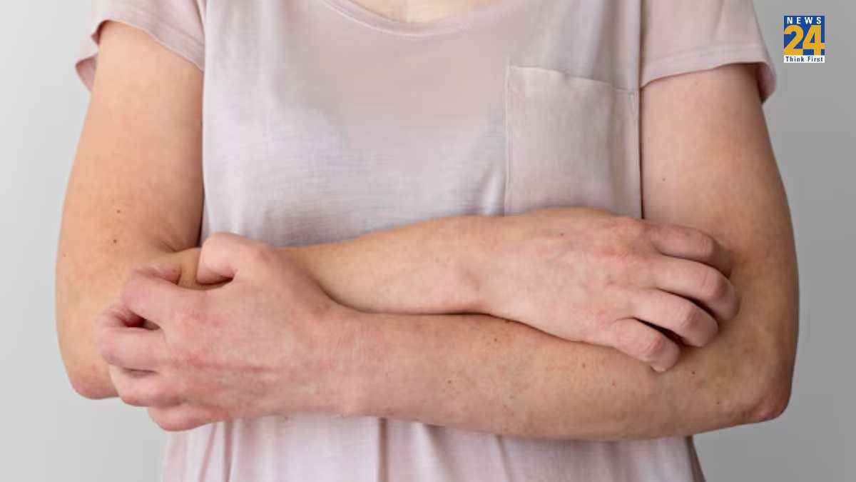 Lupus Symptoms in Women