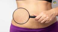 Stretch Marks Home Remedies