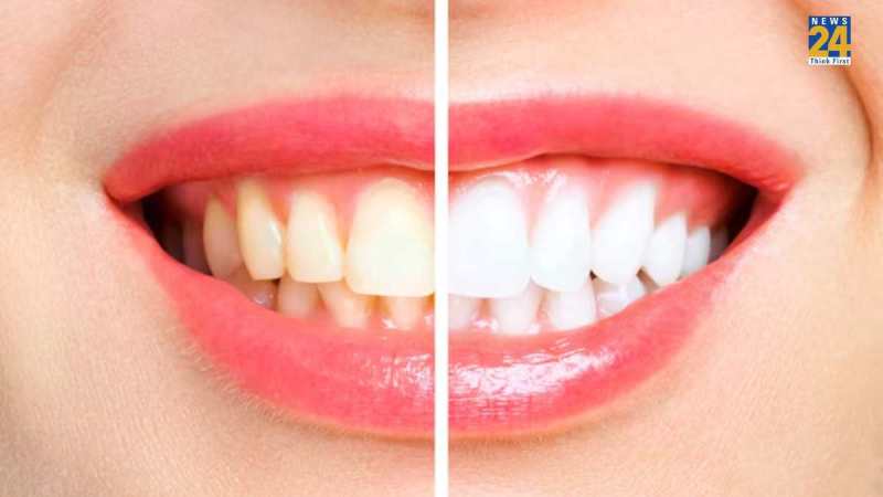 Teeth Whitening Home Remedies