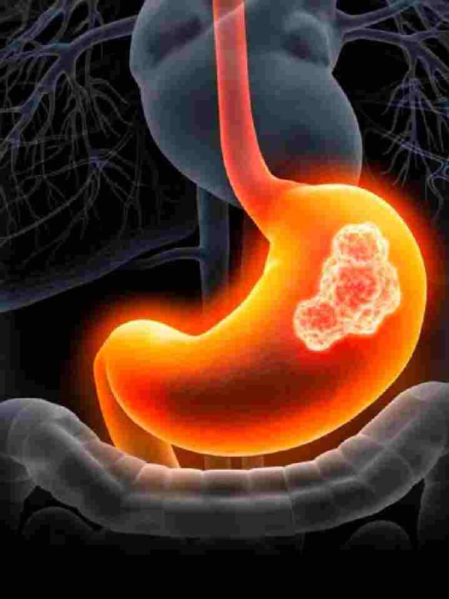Intestine Problems के 5 संकेत