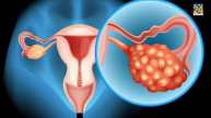 hormones impact ovarian cancer
