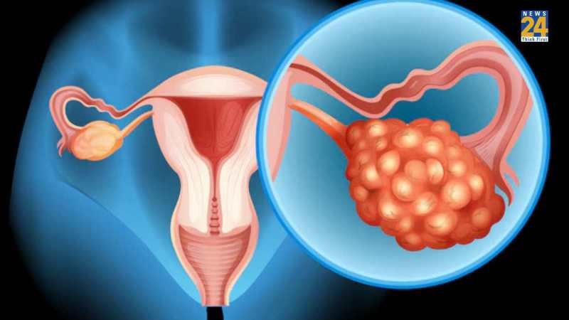 Ovarian Cancer Warning Signs