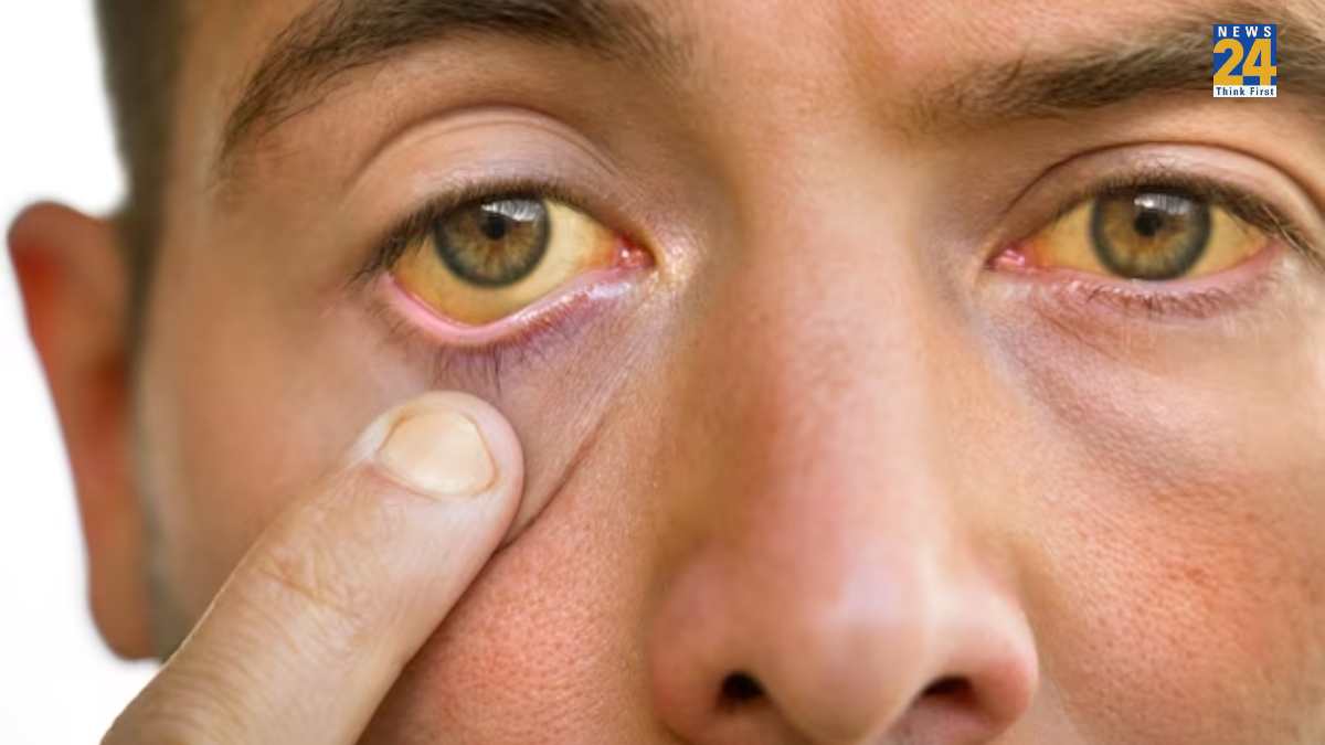 jaundice home remedies