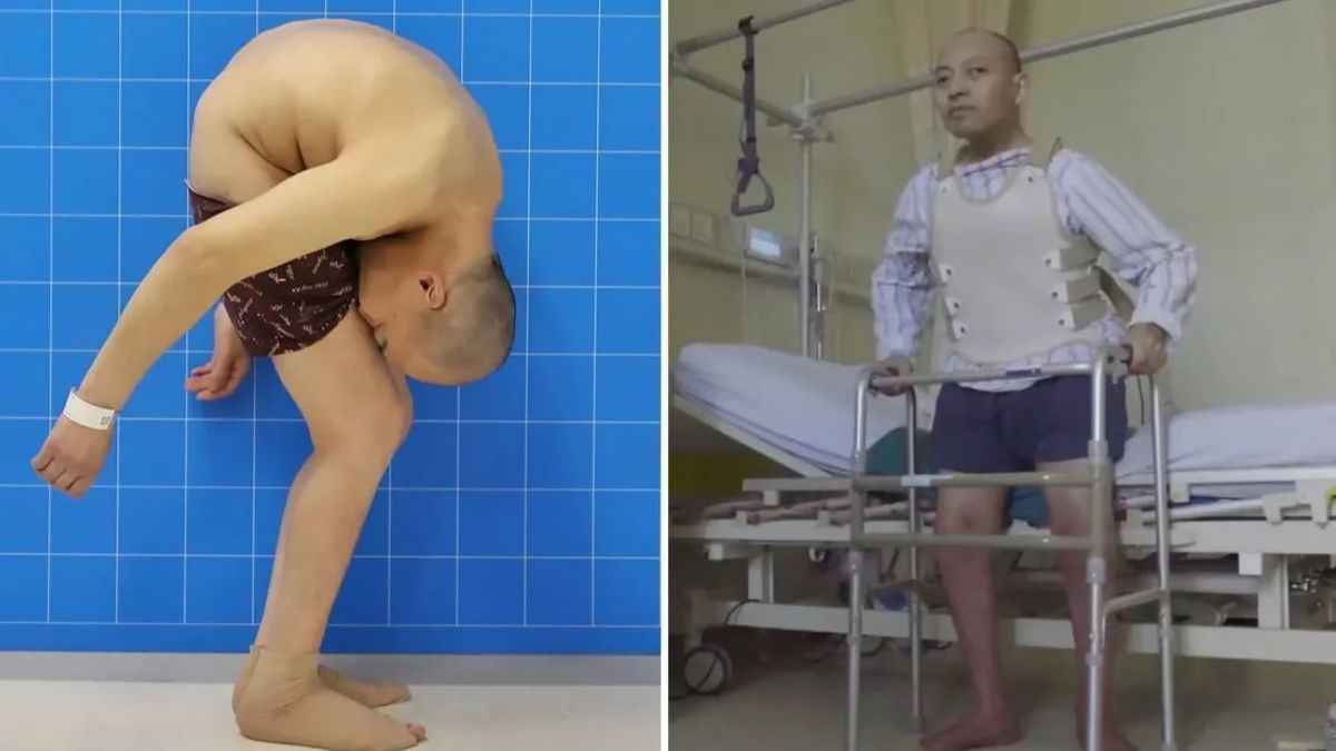चमत्‍कार! घुटने से लगा हुआ था स‍िर, डॉक्‍टर्स ने हड्डियां तोड़कर कर द‍िया कमाल