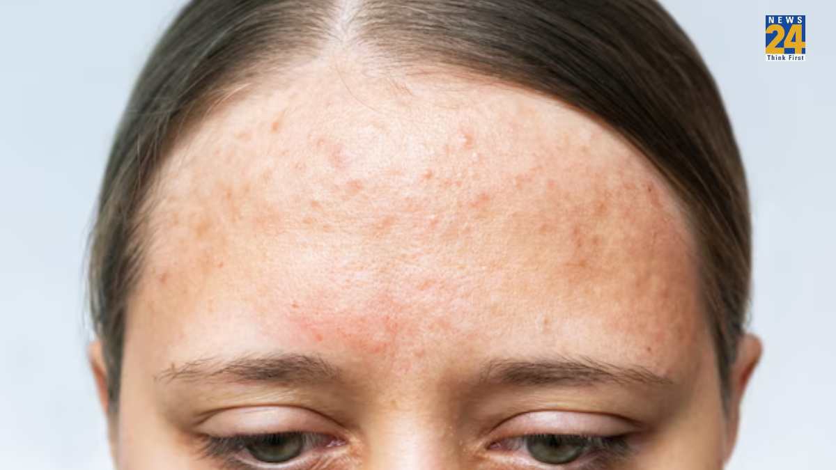 small bumps on forehead