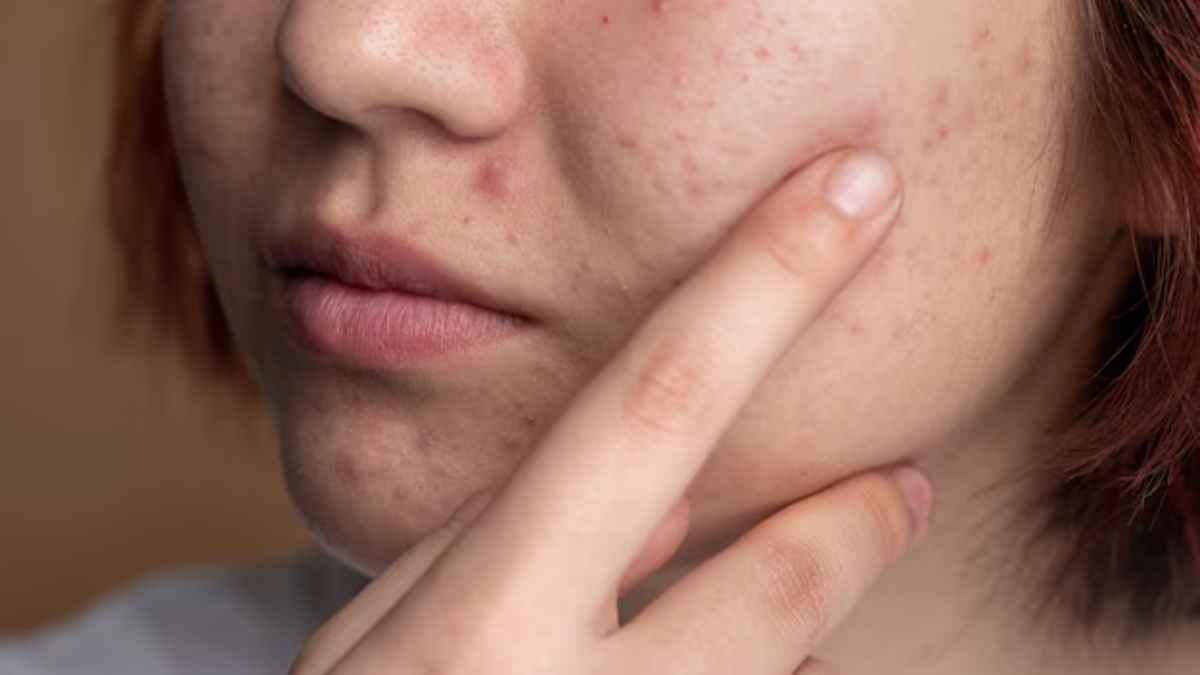 Vitamin C की कमी से स्किन पर दिखते हैं 4 लक्षण