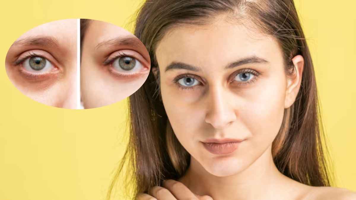 आंखों के नीचे काले घेरे? यहां जानें कारण और बचाव