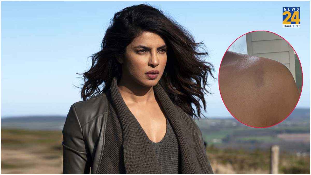 Priyanka Chopra के साथ फिर हादसा, बीते दिन भी लगीं थी चोटें, ताजा तस्वीरें देख परेशान फैंस