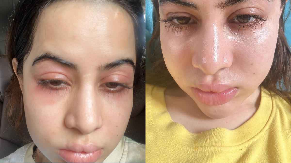 Urfi Javed Swollen Face Reason