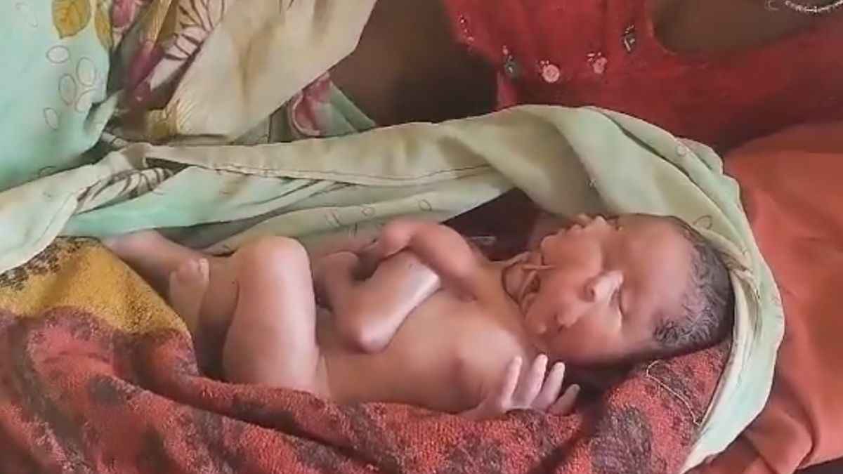 4 पैर, 4 हाथ और 2 मुंह वाला बच्चा, महिला ने अद्भुत बच्चे को दिया जन्म; देखने के लिए अस्पताल में उमड़ी भीड़
