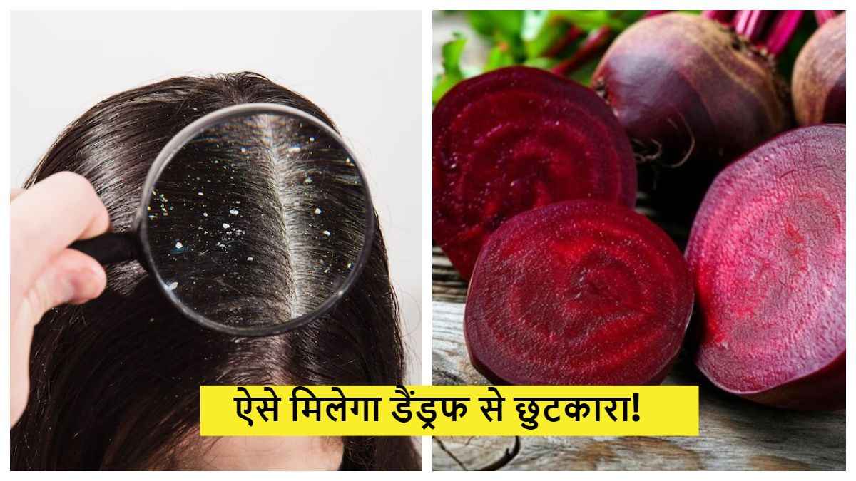 बालों में रूसी की समस्या से हैं परेशान, तो ये घरेलू नुस्खा आएगा काम!