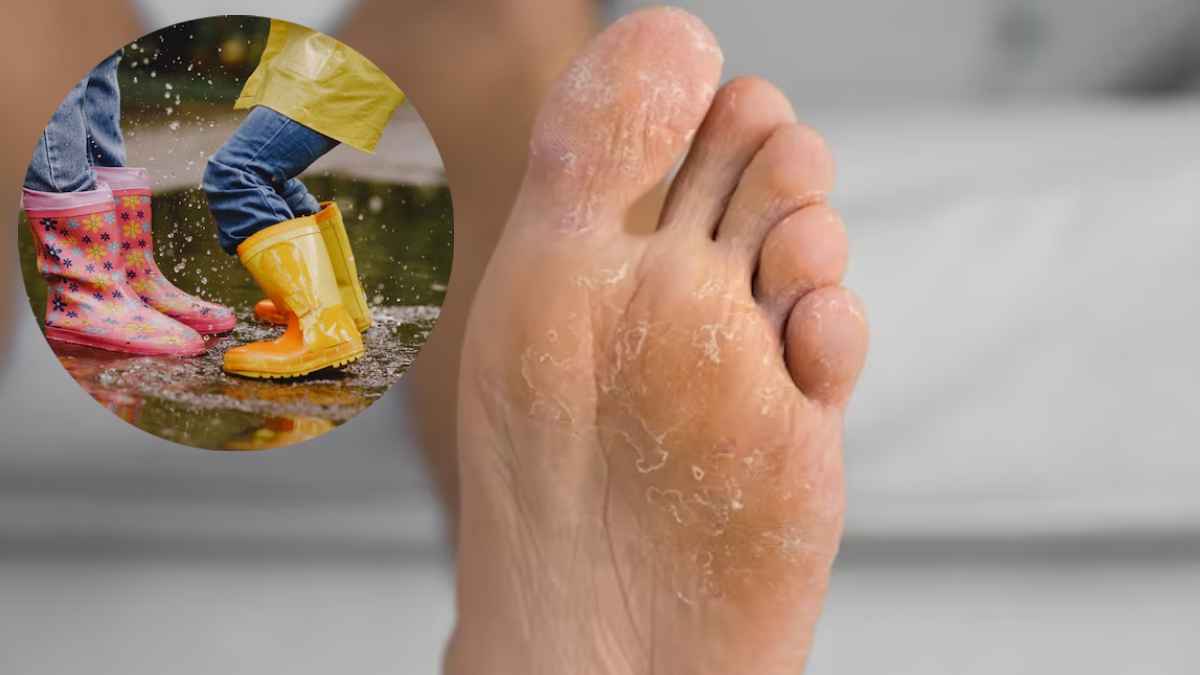 foot infection