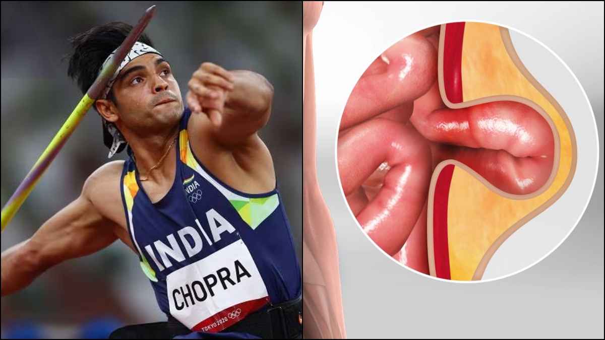 नीरज चोपड़ा को क्यों करवानी पड़ी सर्जरी? जानें कितनी खतरनाक है स्टार एथलीट को हुई बीमारी