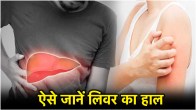 Liver damage symptoms