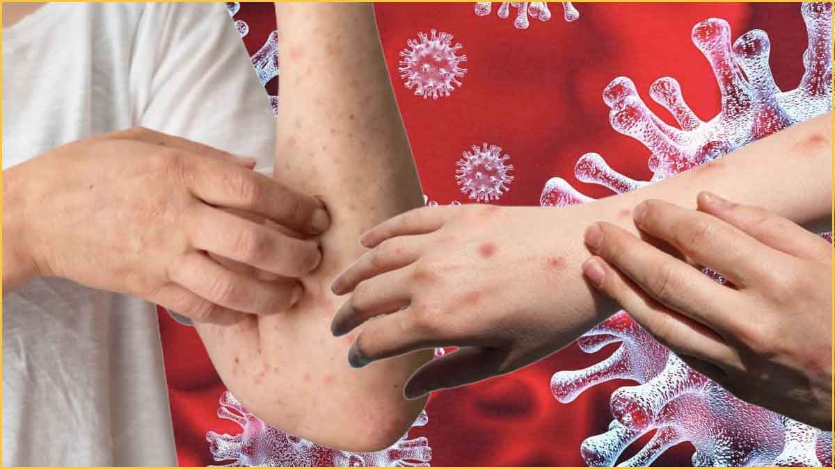 MPox Virus Symptoms