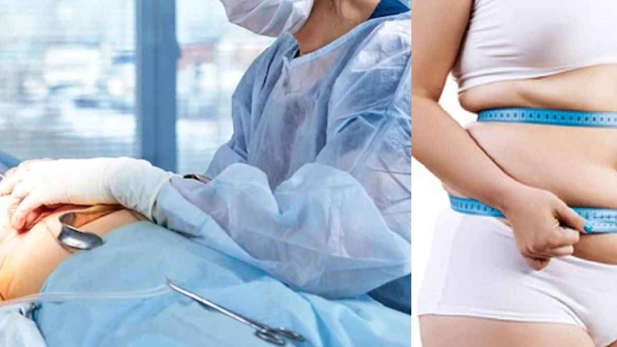 72Kg वजन घटाया...9 सर्जरी; स्लिम दिखने के चक्कर में ये क्या करवा बैठी महिला? जाते-जाते बची जान