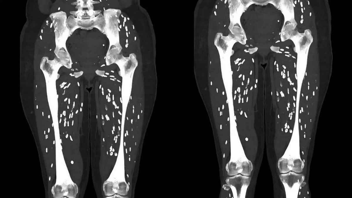 Cysticercosis